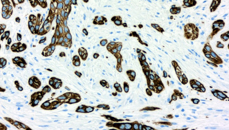 Bauchspeicheldrüsenkrebs: Wie sein Widerstand gegen Chemotherapien gebrochen  werden kann