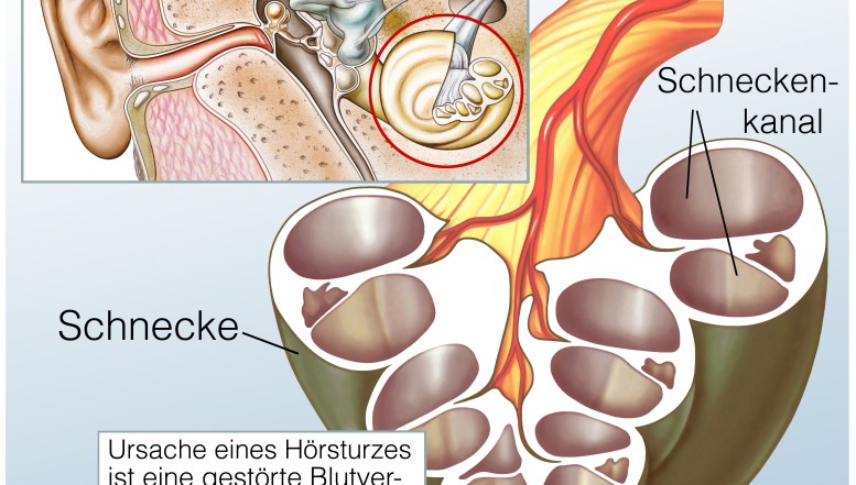 Wann Sie mit Hörsturz zum Arzt sollten