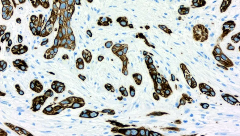 Bauchspeicheldrüsenkrebs: Wie sein Widerstand gegen Chemotherapien gebrochen  werden kann